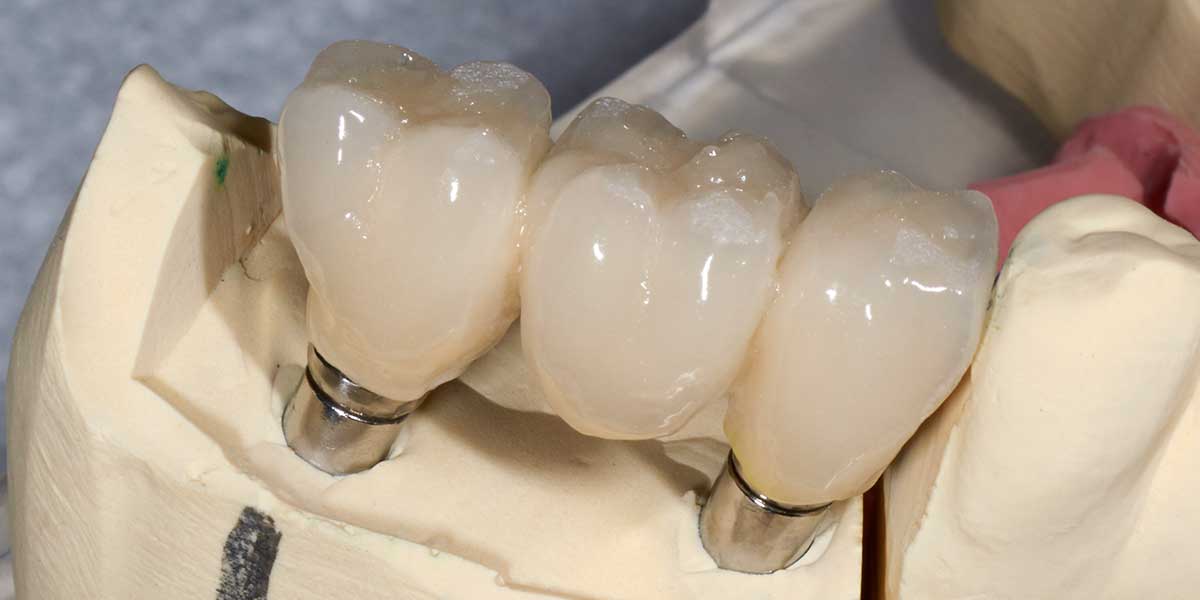 Dental Implant Supported Bridges in OKC