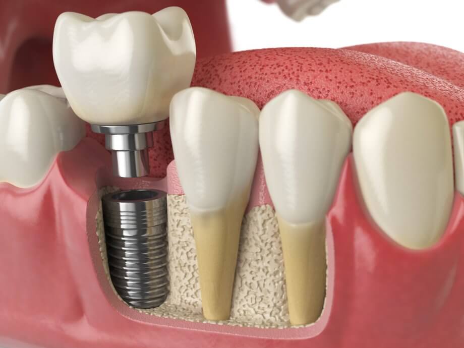 Choose OMA for Dental Implants