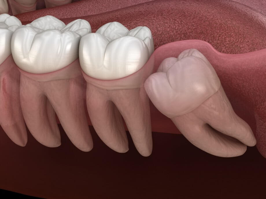 Impacted Wisdom Tooth