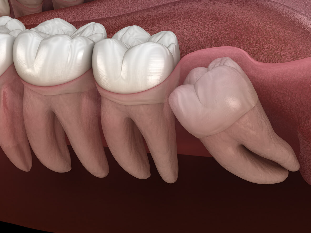 Are Your Wisdom Teeth Keeping You Awake At Night Oral Maxillofacial Associates