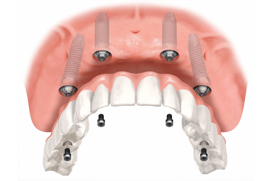 Four implants in clay model