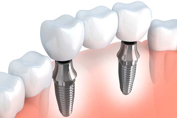 Implant Supported Bridges in Oklahoma