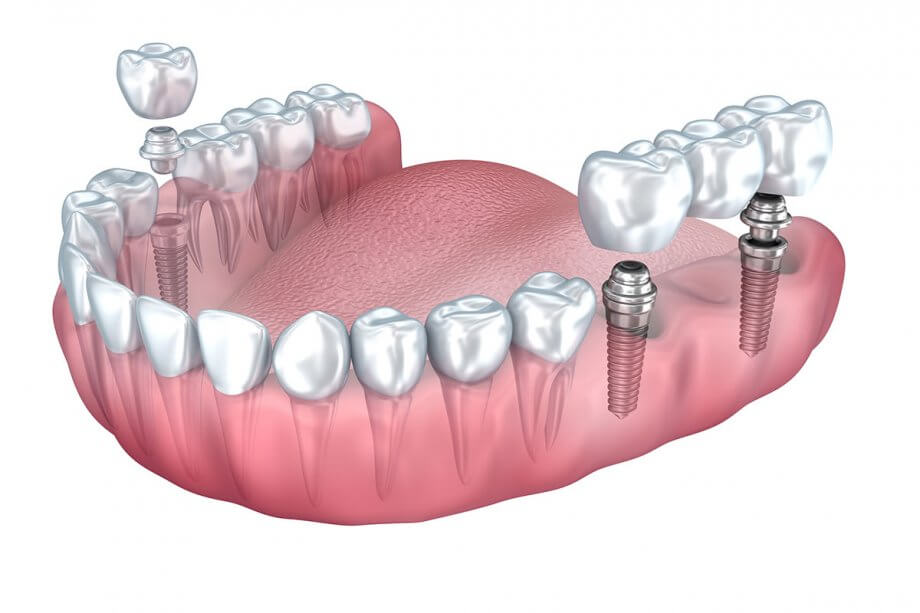 Dental Implant vs Bridge: Know Your Options